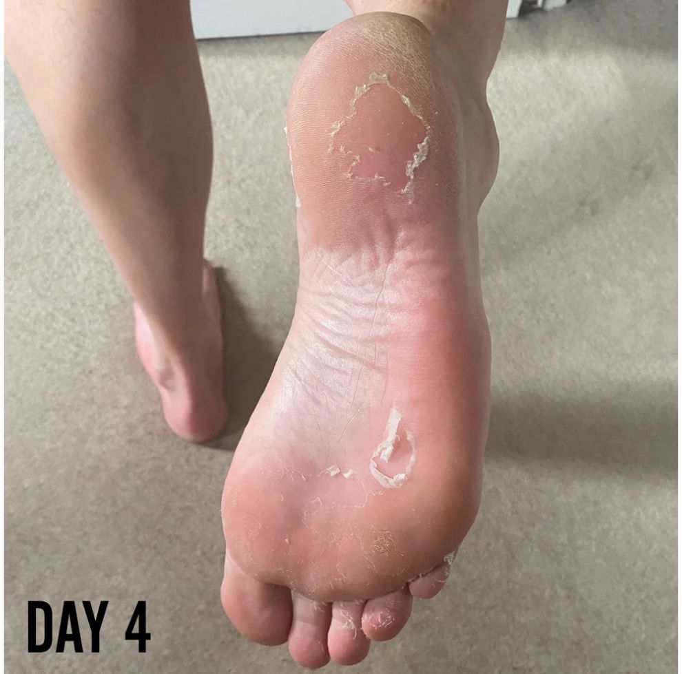 Barber Pro Foot Peel